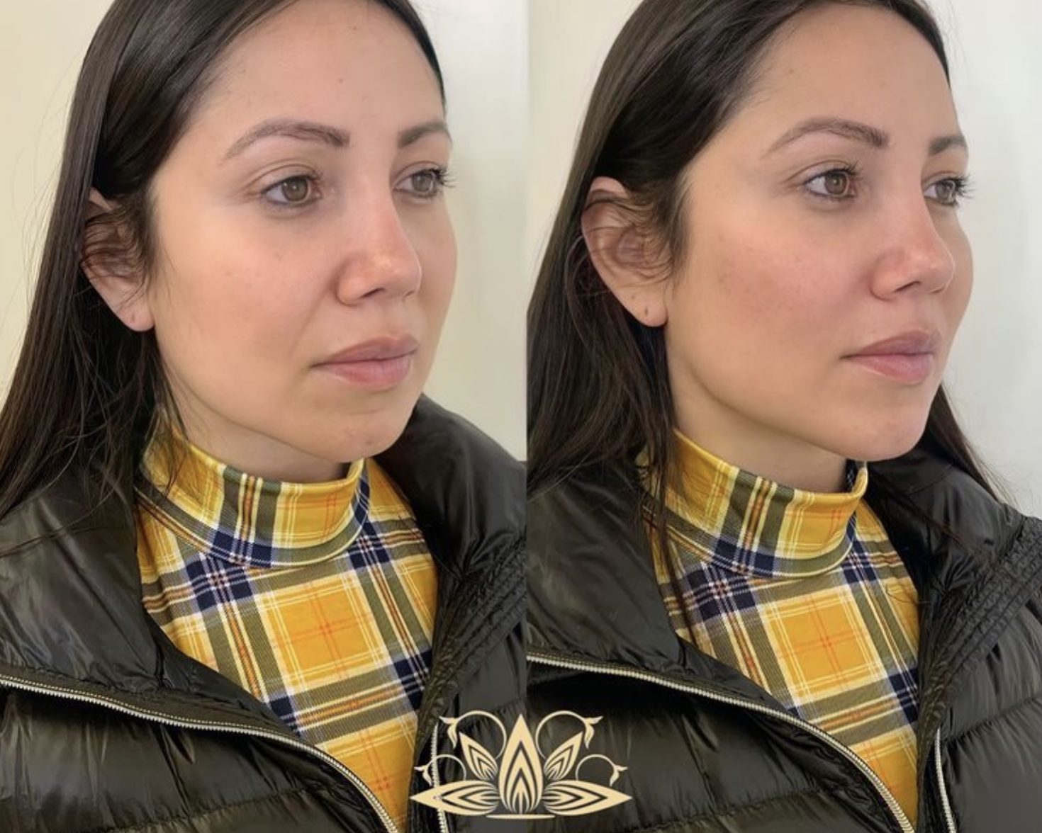 Snatched Chin And Jawline | Non-Surgical Facelift | Highland Park IL