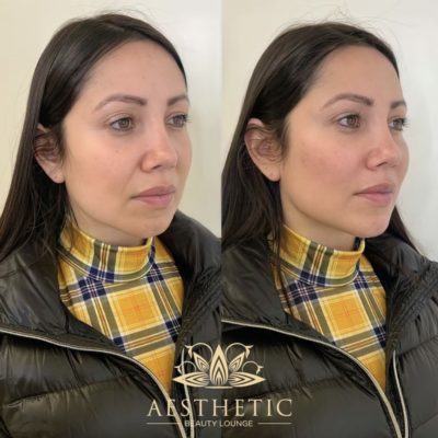 Snatched Chin And Jawline | Non-Surgical Facelift | Highland Park IL