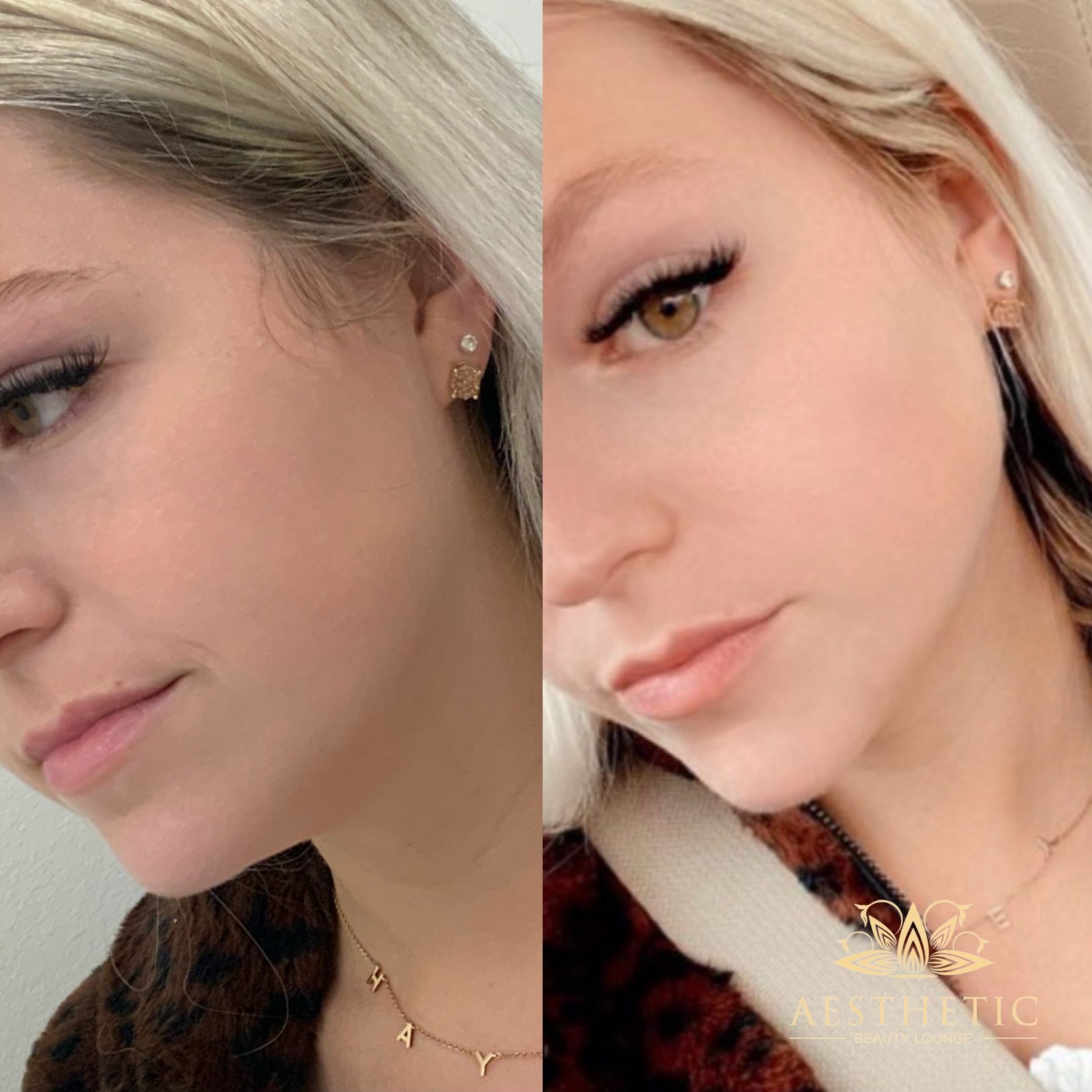 Jawline Contour Package