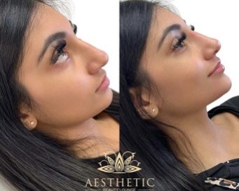 Melt Fat Package – Kybella