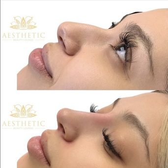 Non-Surgical Nose Job (NSNJ)