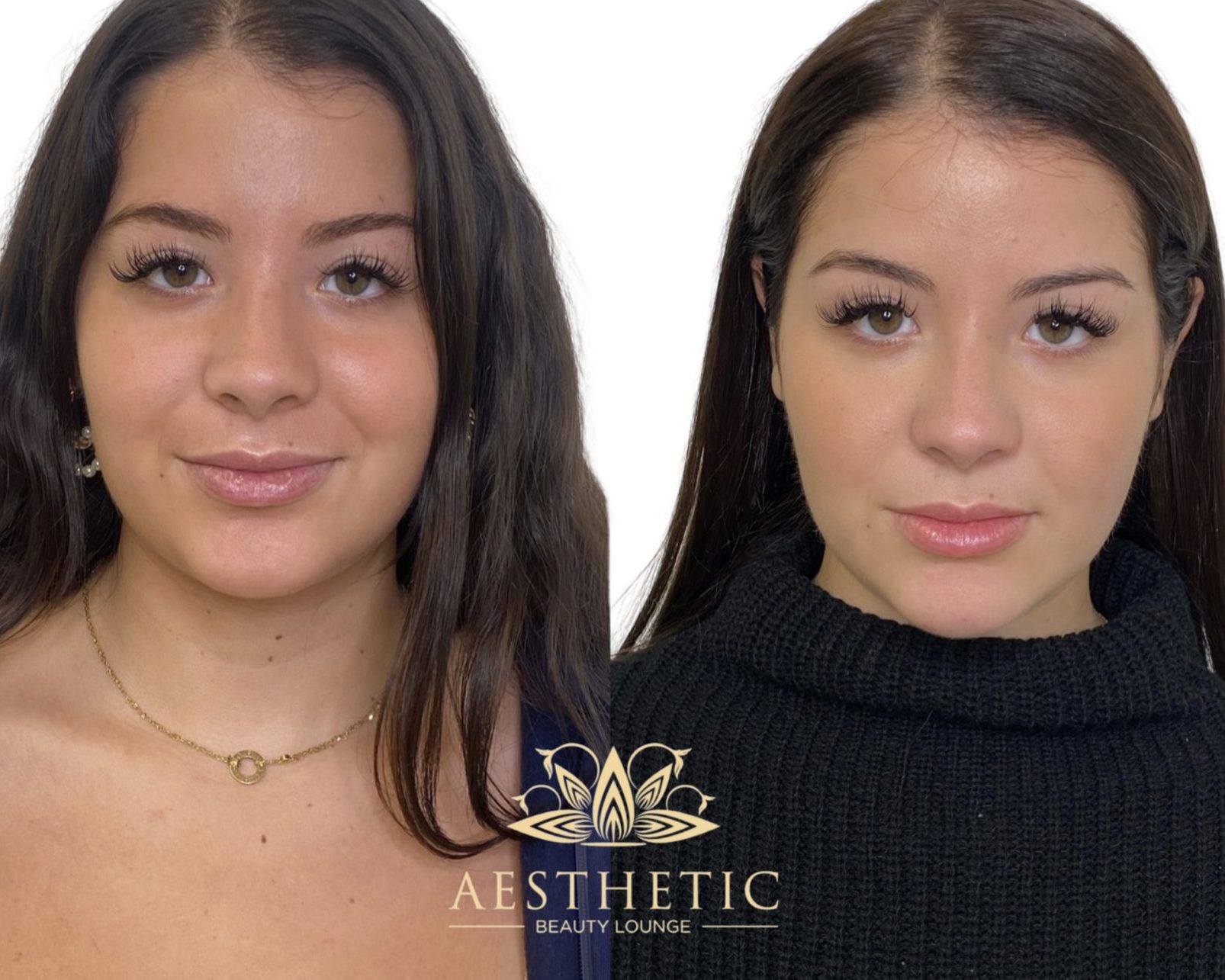 Cheek Contouring Specialist | Cheekbone Contour Fillers | Highland Park IL