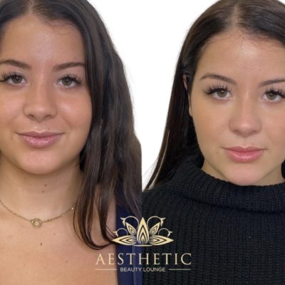 Cheek Contouring Specialist | Cheekbone Contour Fillers | Highland Park IL