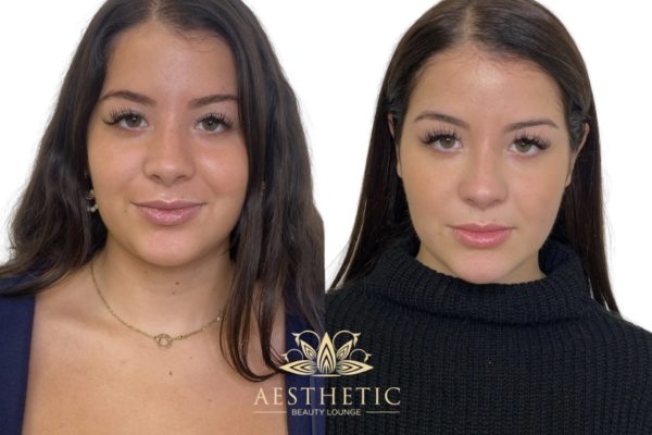 Cheek Contouring Specialist | Cheekbone Contour Fillers | Highland Park IL Cheek Contouring Specialist | Cheekbone Contour Fillers | Highland Park IL