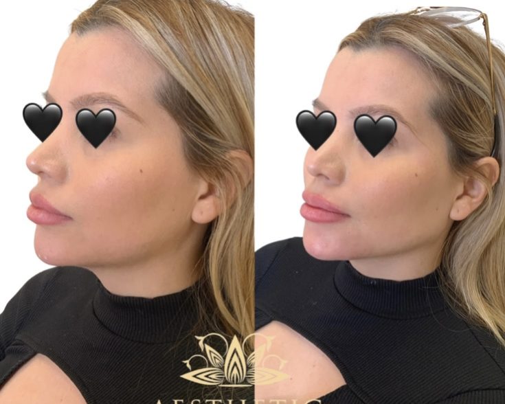 Jawline Contour Package