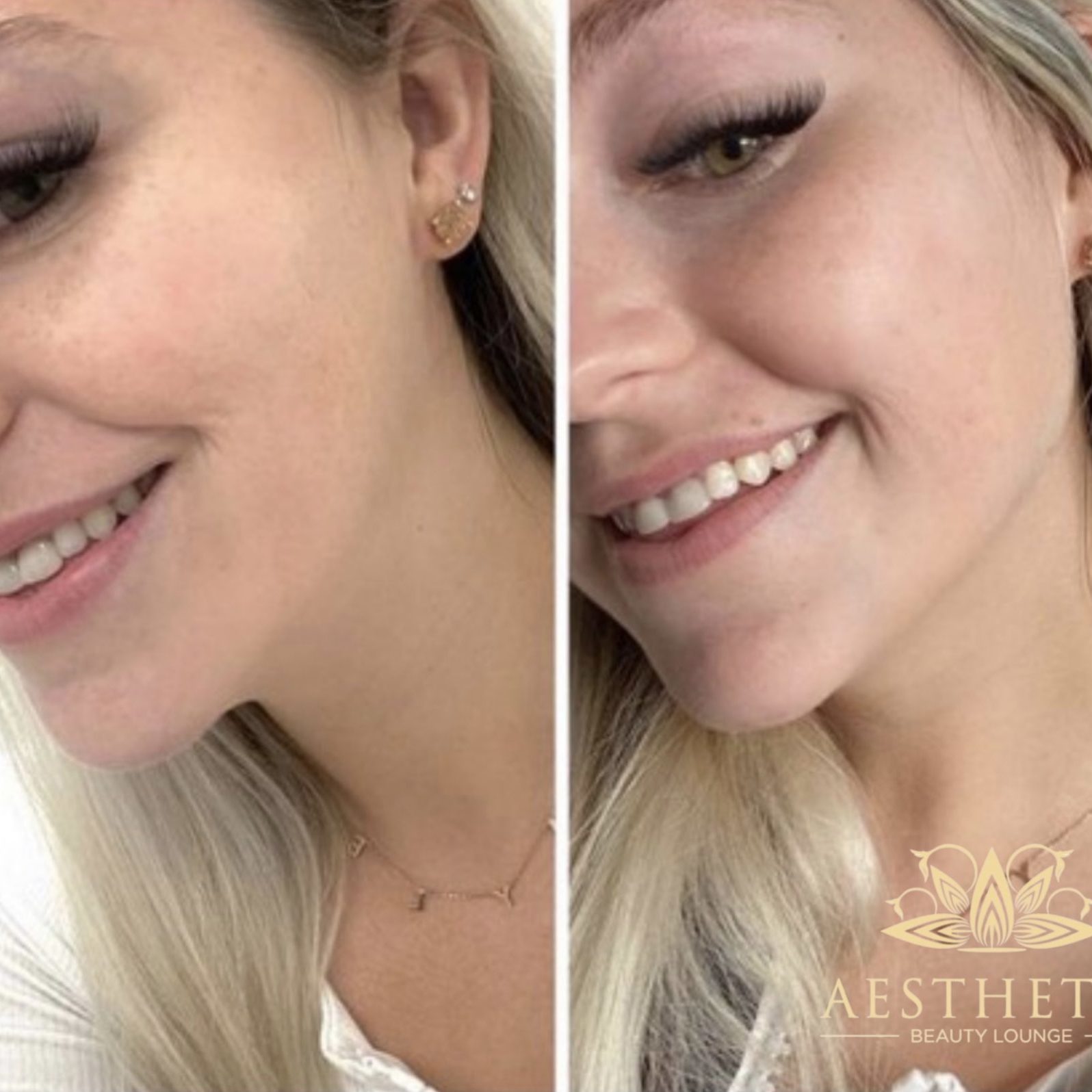 Jawline Contour Package