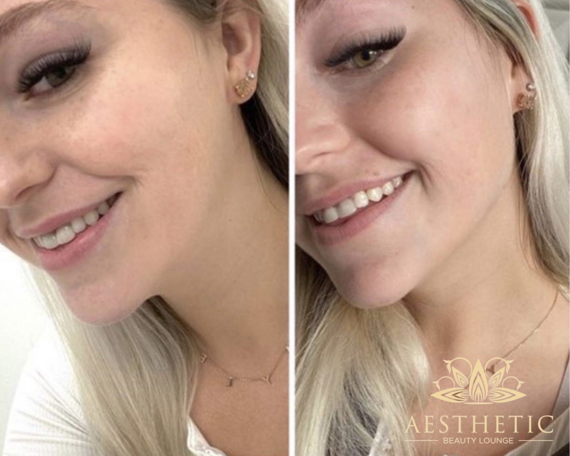 Jawline Contour Package