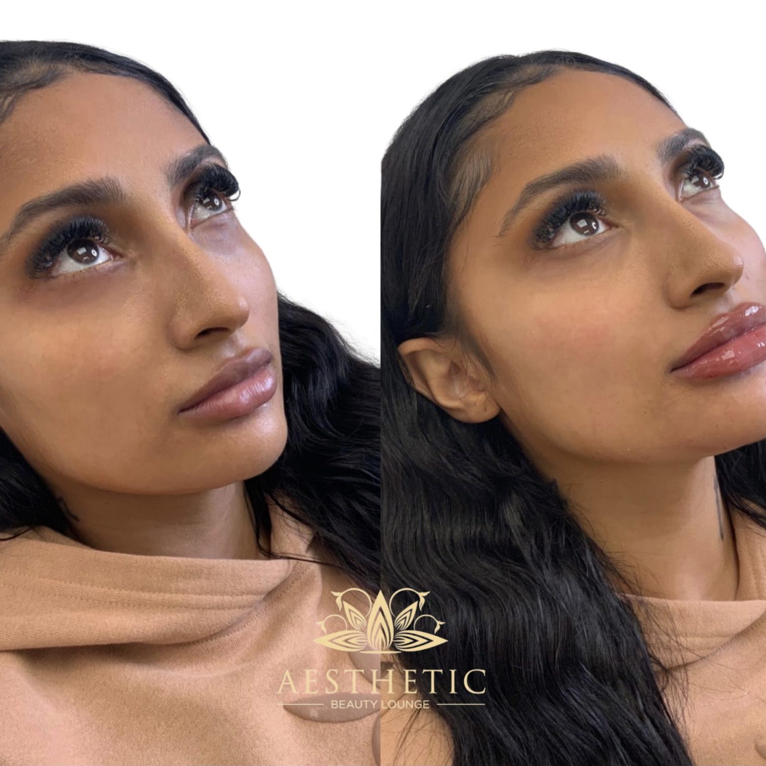 Melt Fat Package – Kybella