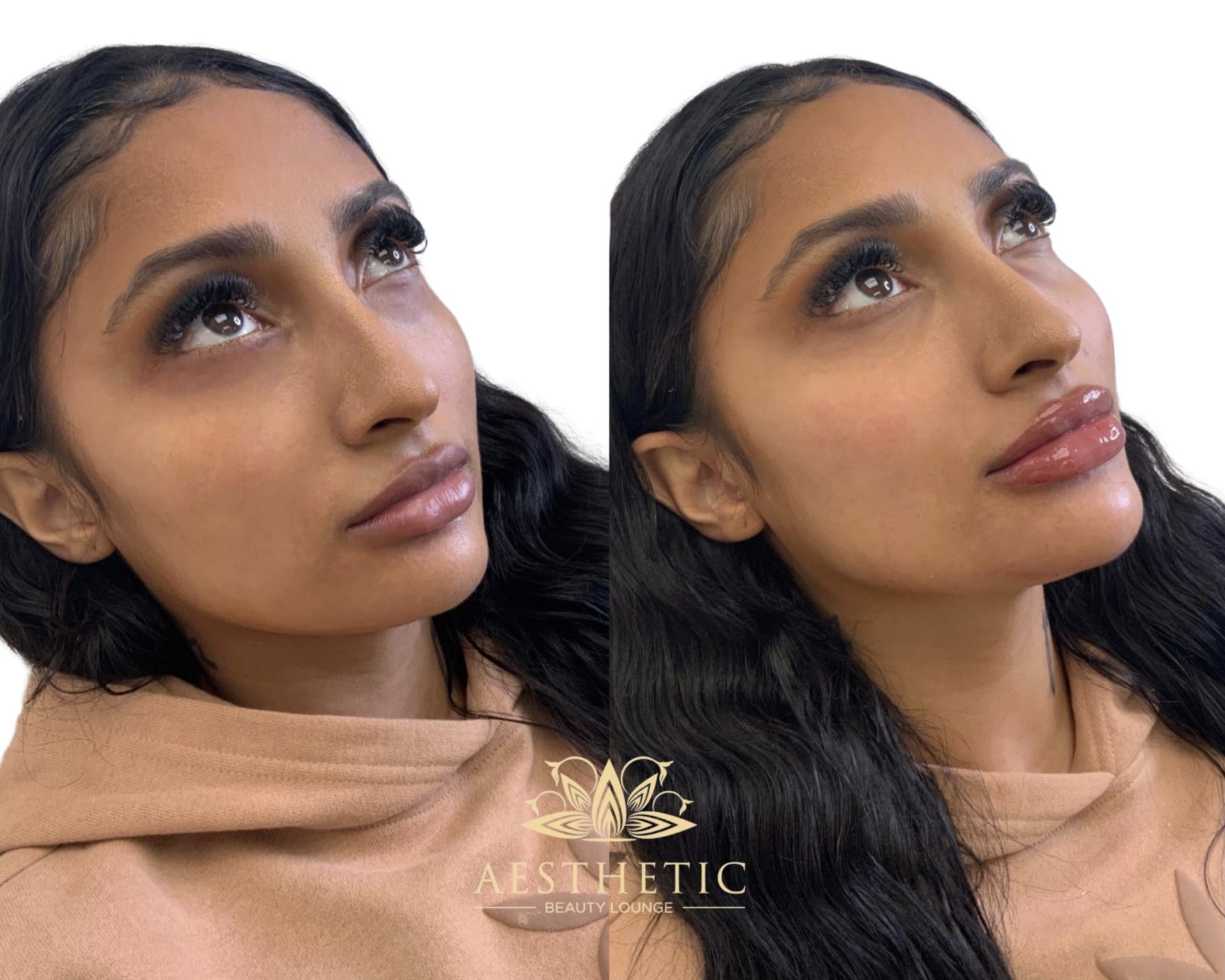 Melt Fat Package – Kybella