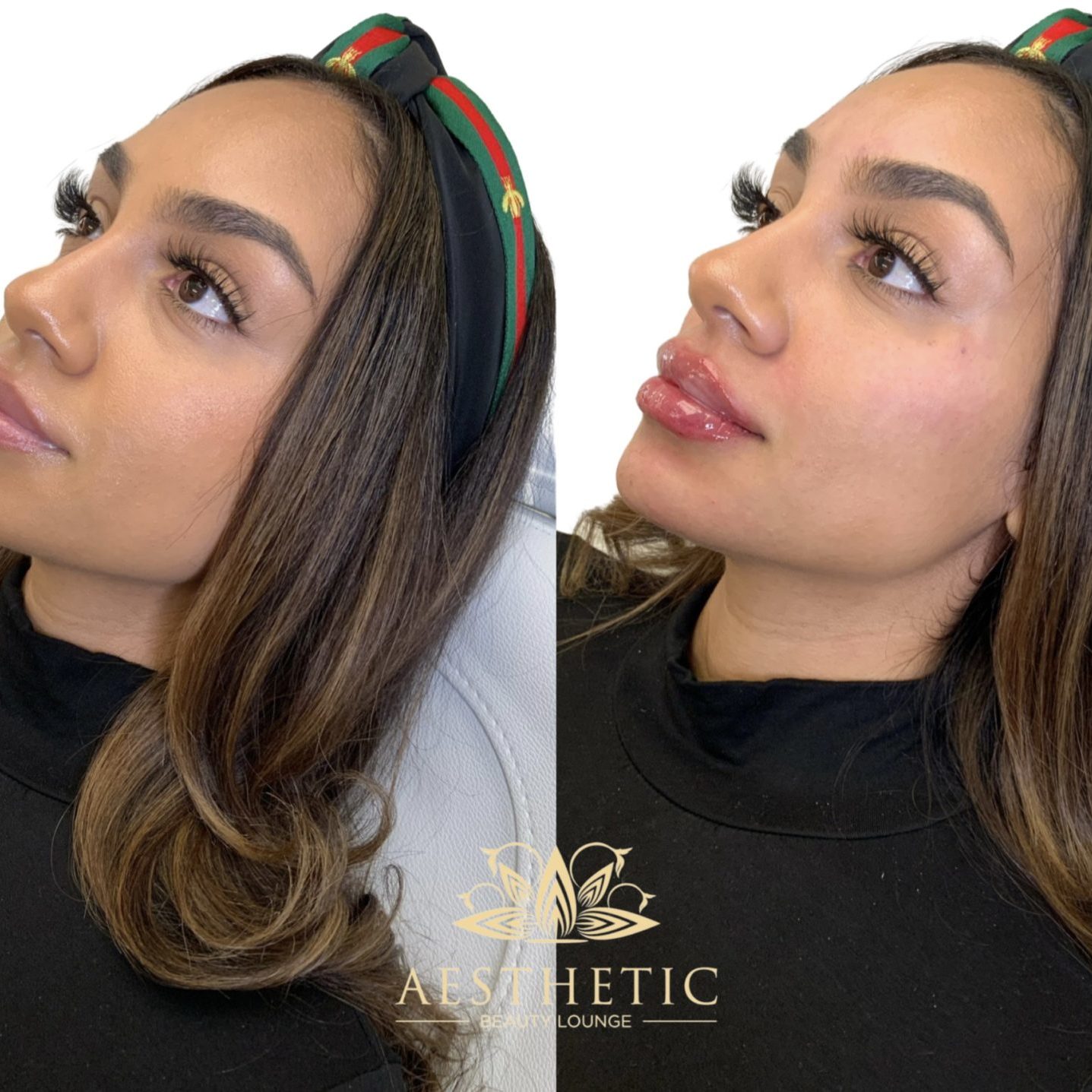 Melt Fat Package – Kybella