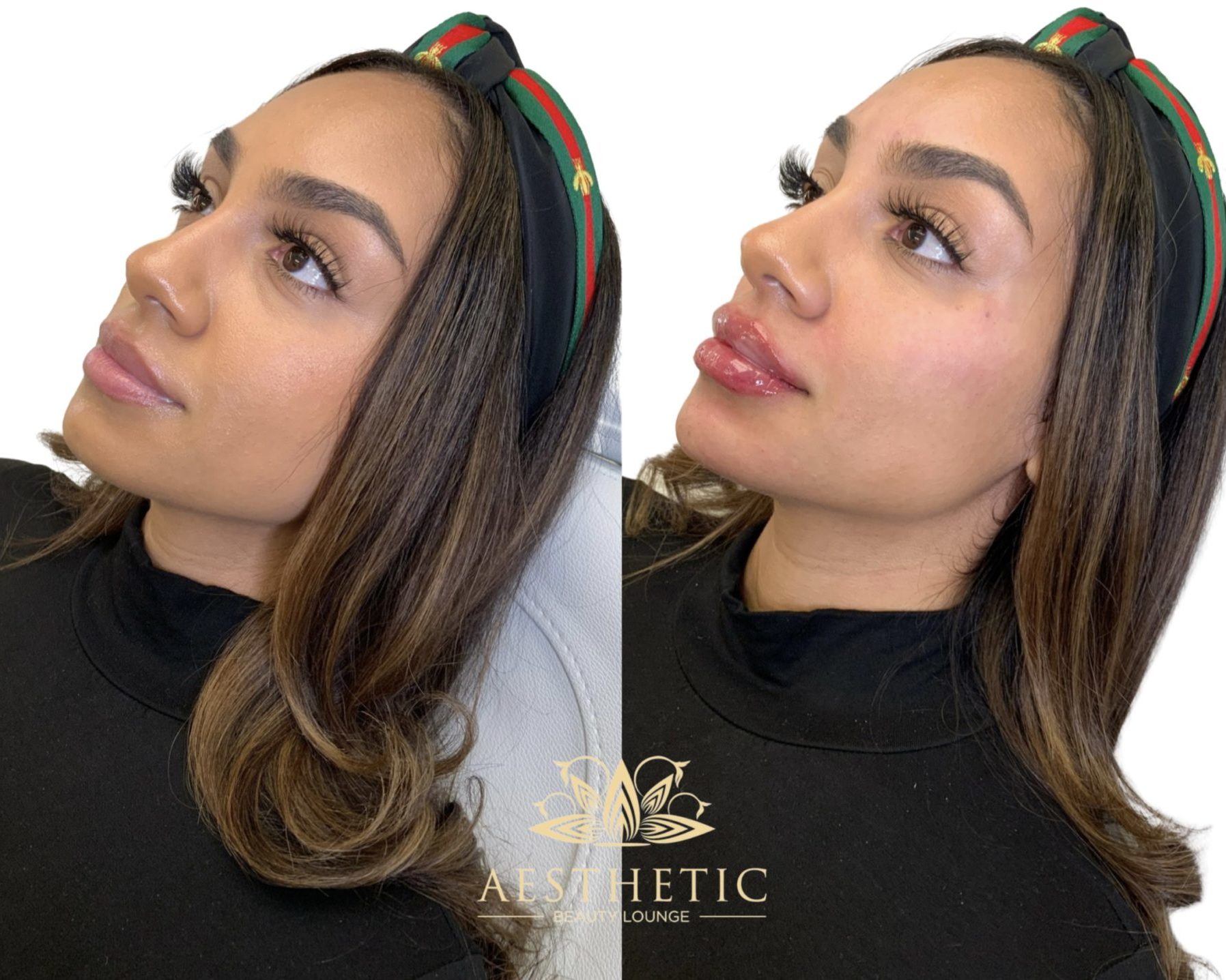 Melt Fat Package – Kybella