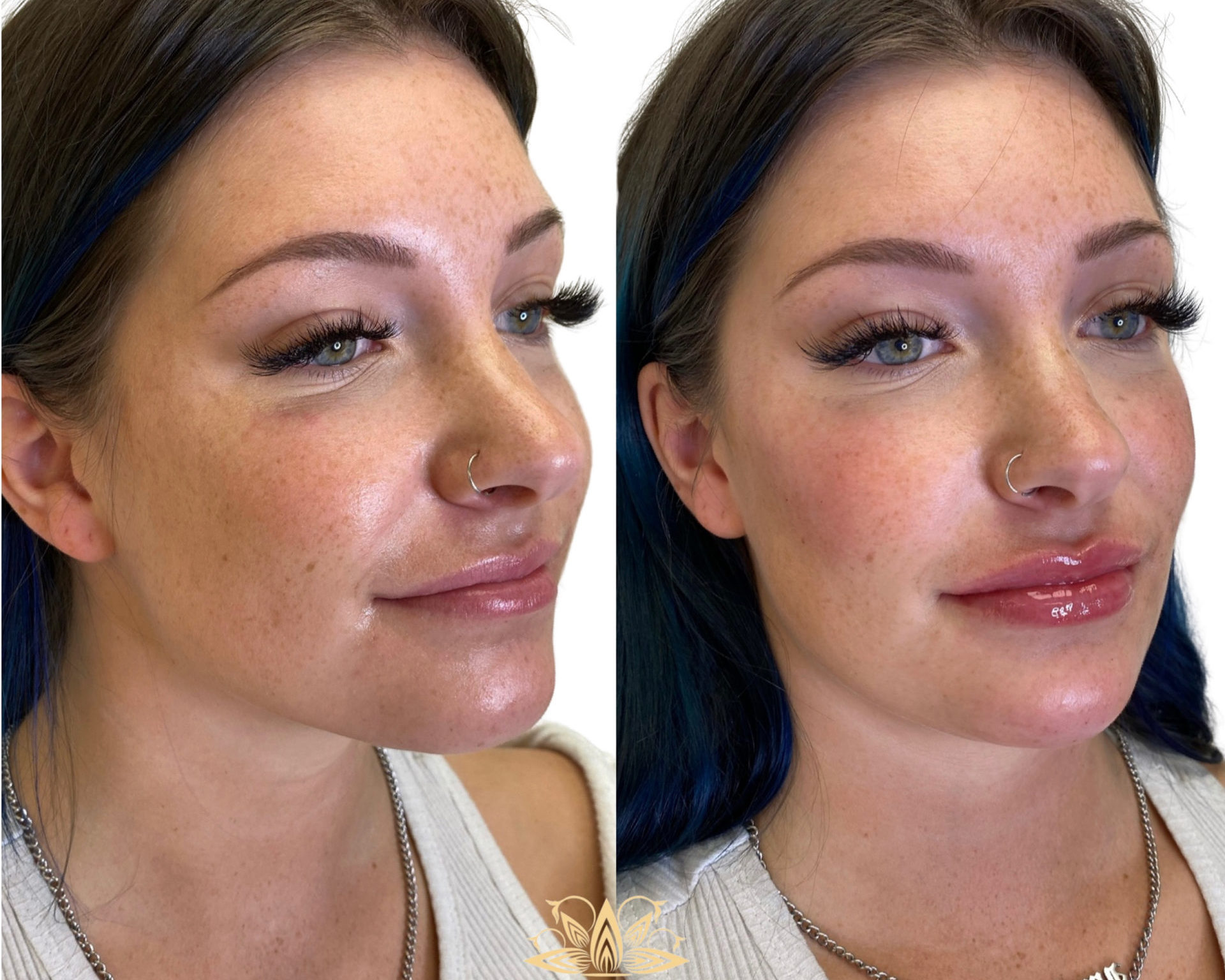 Filler To Jawline, Chin, Lips, And Cheeks | Facial Sculpting Specialists