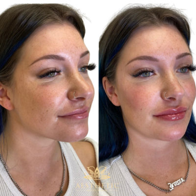 Filler To Jawline, Chin, Lips, And Cheeks | Facial Sculpting Specialists