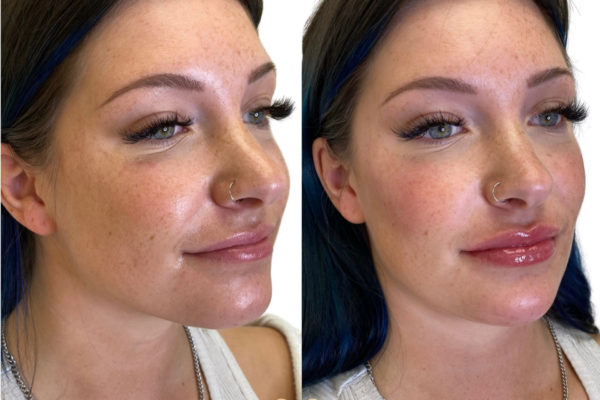 Filler To Jawline, Chin, Lips, And Cheeks | Facial Sculpting Specialists