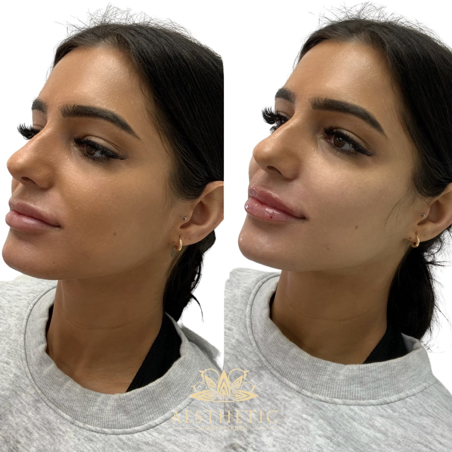 Melt Fat Package – Kybella
