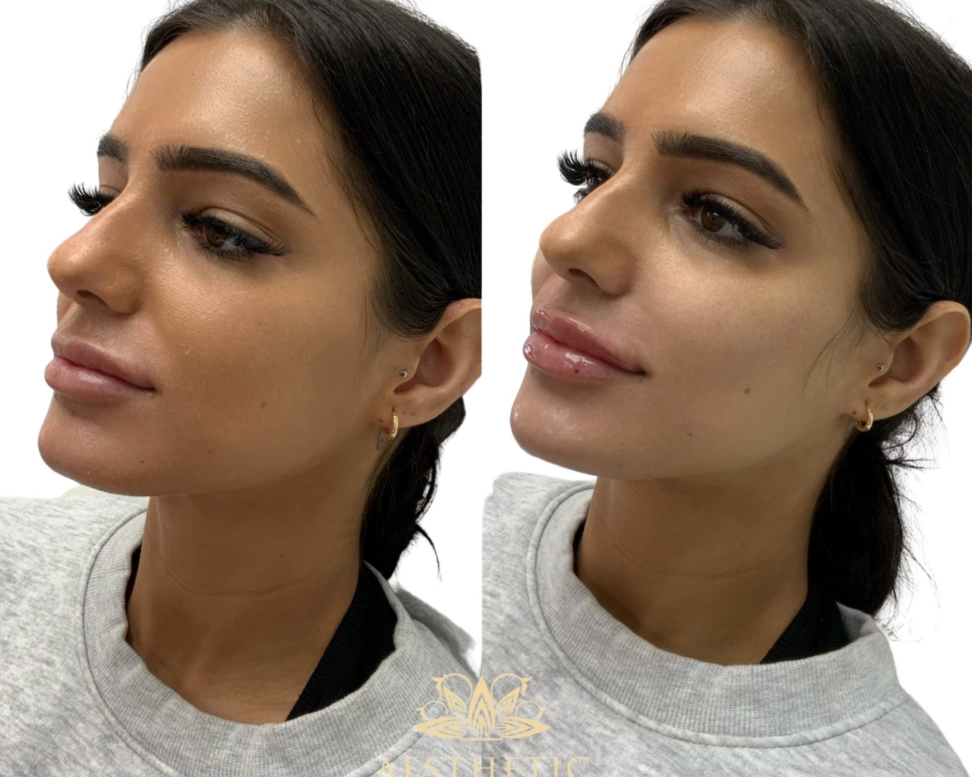 Melt Fat Package – Kybella