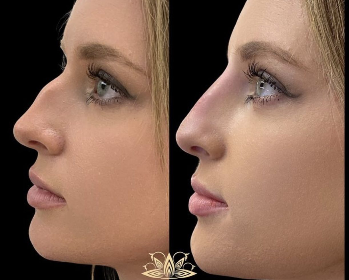 Non-Surgical Nose Job