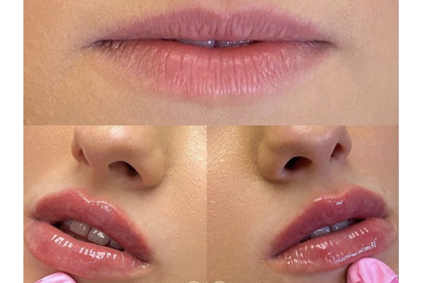 Kyssable Lips_ Aesthetic beauty lounge