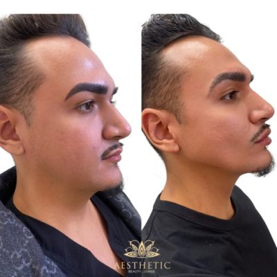 Jawline contour _ Aesthetic beauty lounge