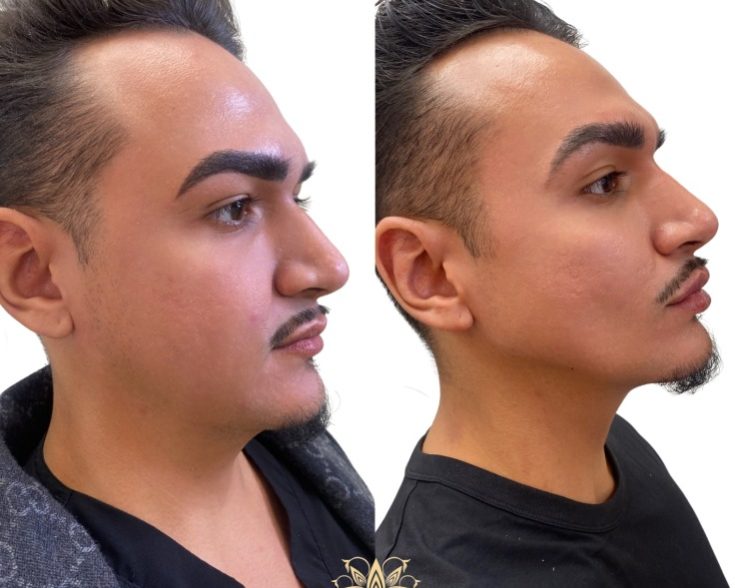 Jawline contour _ Aesthetic beauty lounge