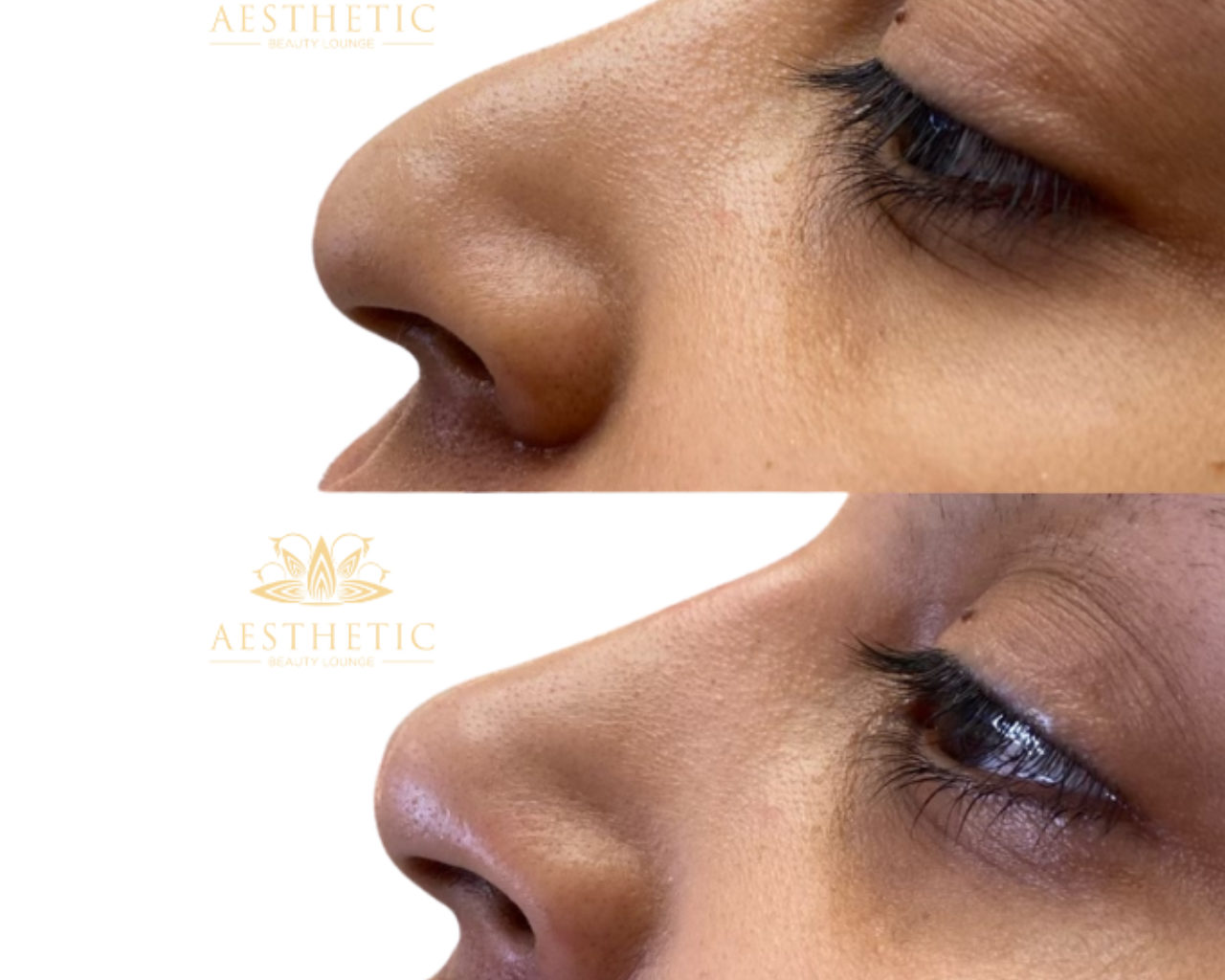 Non-Surgical Nose Job_ Aesthetic beauty lounge