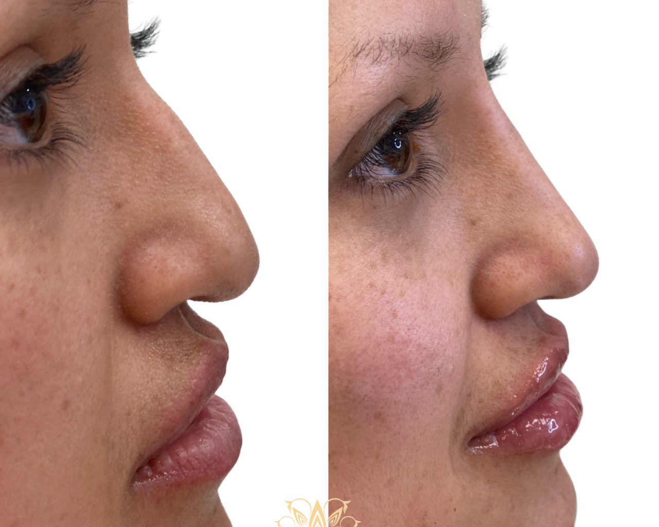 Non-Surgical Nose Job_ Aesthetic beauty lounge