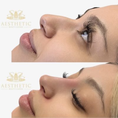 Rhinoplasty before and after