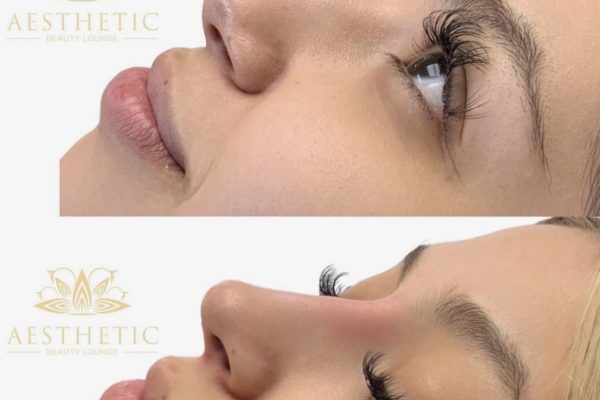 Rhinoplasty before and after