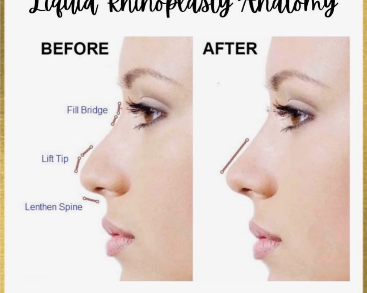 Rhinoplasty before and after