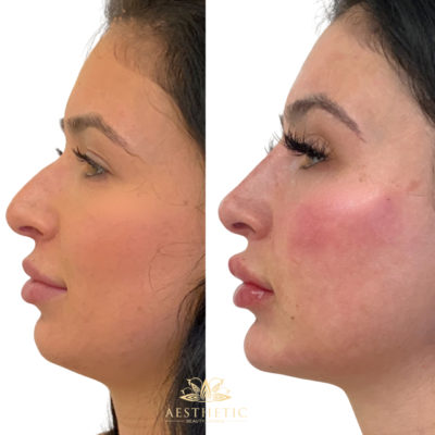 Sculptra packages