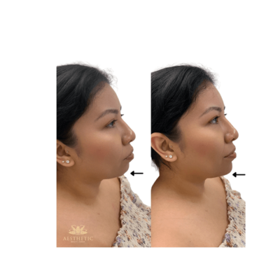 Chin Defynition Before and after