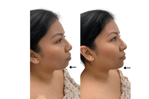 Chin Defynition Before and after