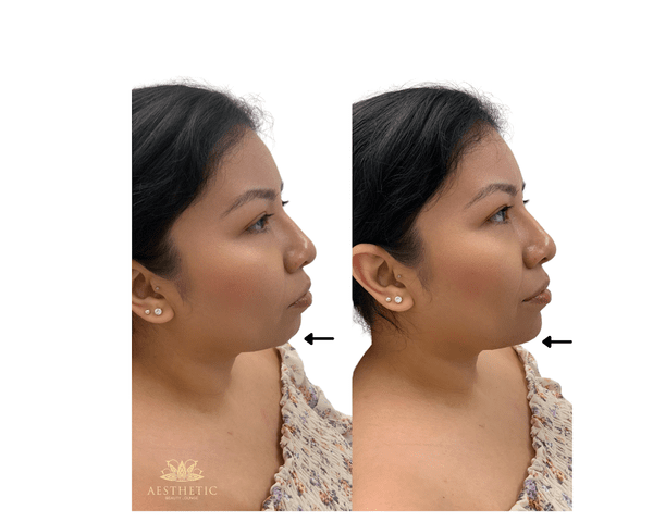 Chin Defynition Before and after