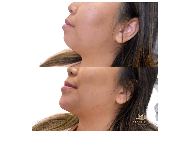 Chin Defynition Before and after