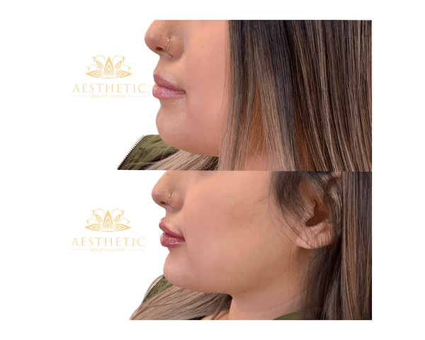 Chin Defynition Before and after