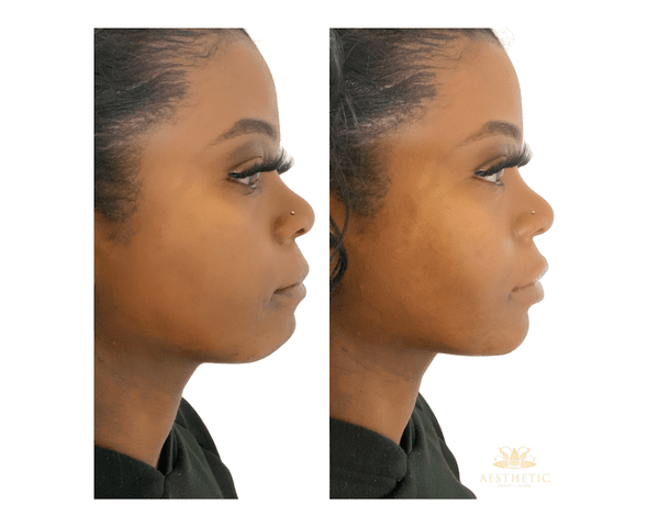 Chin Defynition Before and after
