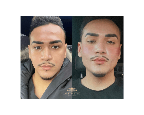 Jawline Contour Package _Aesthetic Beauty Lounge