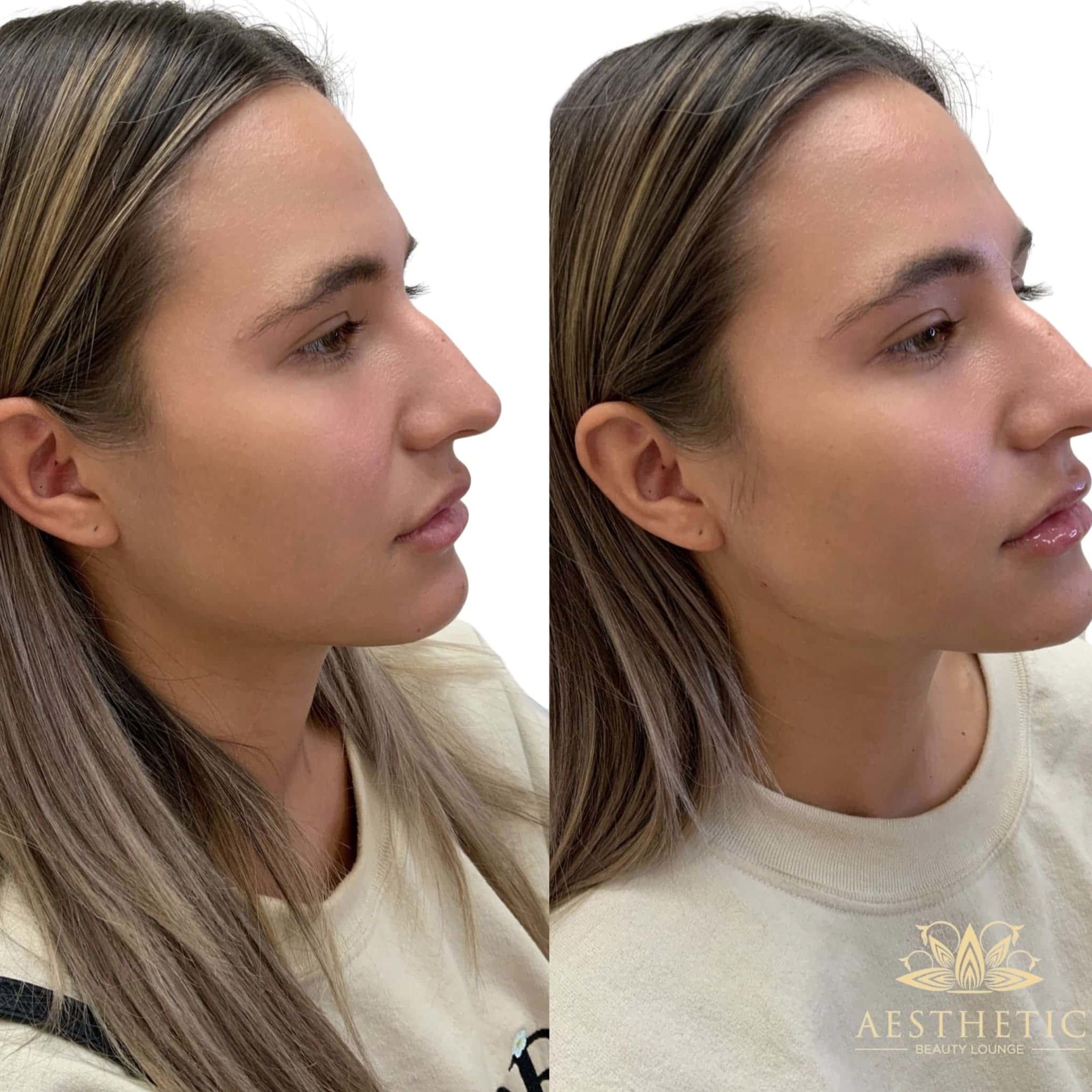 Jawline Contour Package_ Aesthetic beauty lounge
