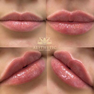 Lip Augmentation| Lip Filler And Enhancement | Highland Park IL