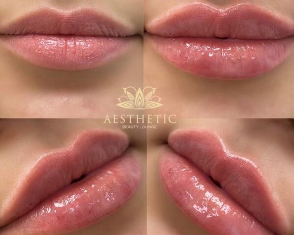 Lip Augmentation| Lip Filler And Enhancement | Highland Park IL