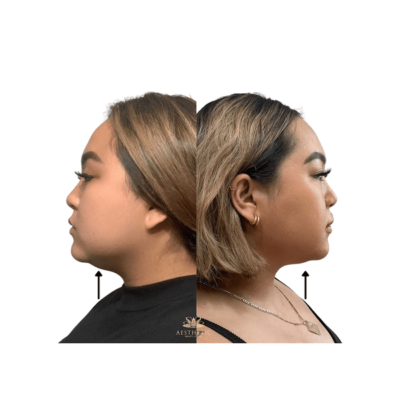 Melt Fat Package – Kybella Before and after