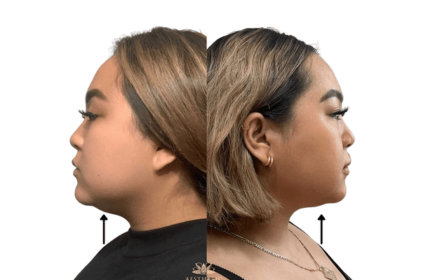 Melt Fat Package – Kybella Before and after