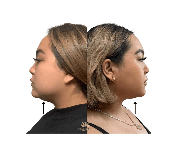 Melt Fat Package – Kybella Before and after