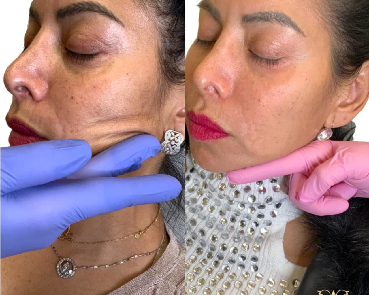 Sculptra Vs. Dermal Fillers | Skin Rejuvenation Injectable Filler
