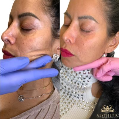 Sculptra Vs. Dermal Fillers | Skin Rejuvenation Injectable Filler