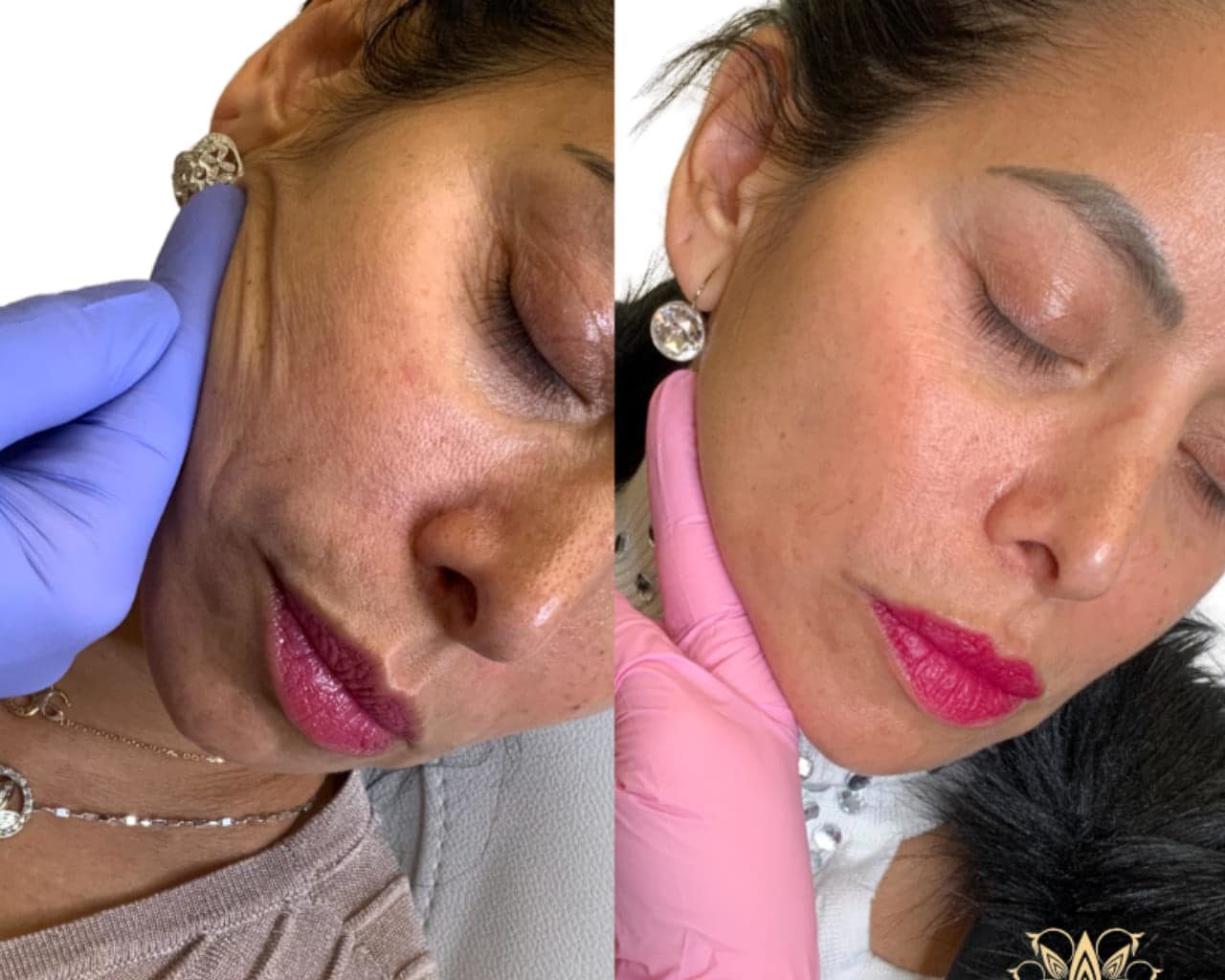 Vampire Facial Package | Microneedling With PRP | Microneedling With PRF
