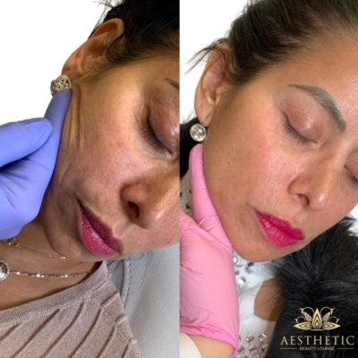 Vampire Facial Package | Microneedling With PRP | Microneedling With PRF