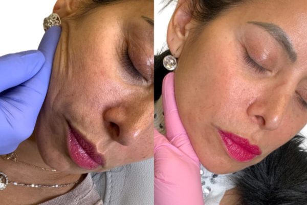 Vampire Facial Package | Microneedling With PRP | Microneedling With PRF